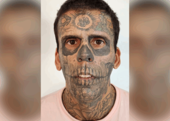 tatoeage verwijderen